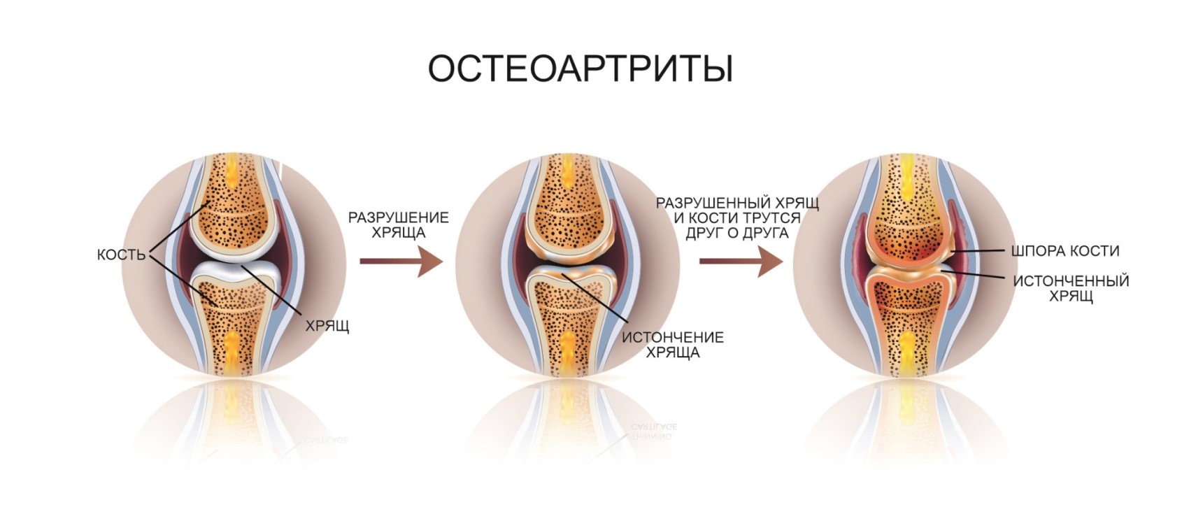 Preview Descoberto Fator Inesperado no Desenvolvimento da Osteoartrite