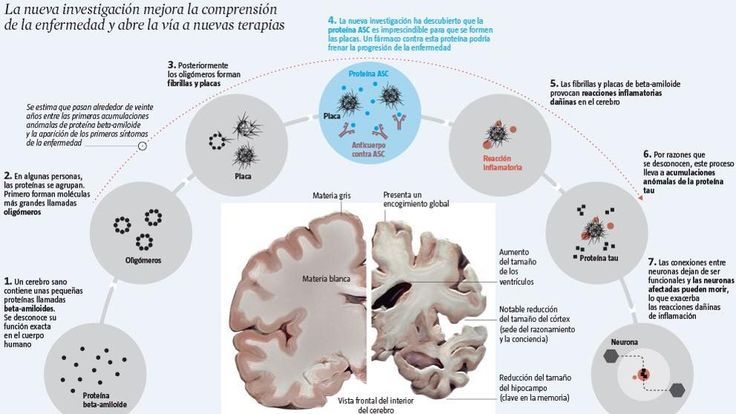 Preview Criado Método de Previsão Precoce da Doença de Alzheimer