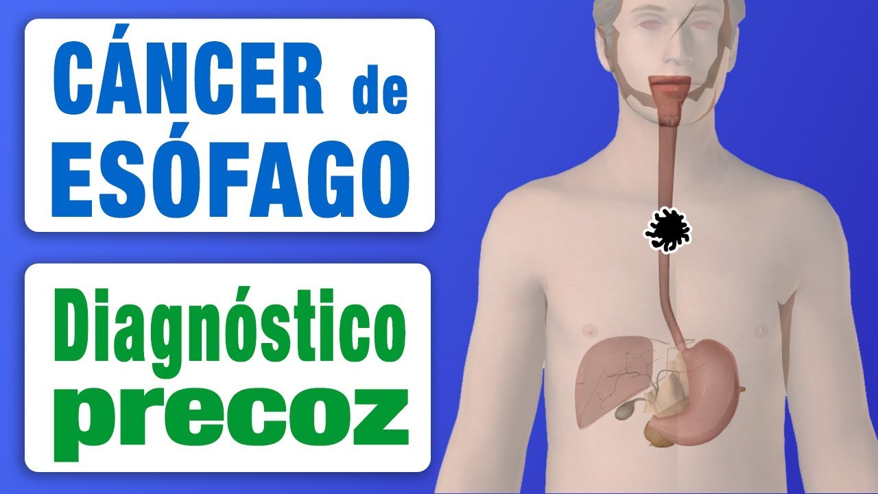 Preview Novo Método Revolucionário Detecta Câncer de Esôfago Precocemente e Sem Biópsia