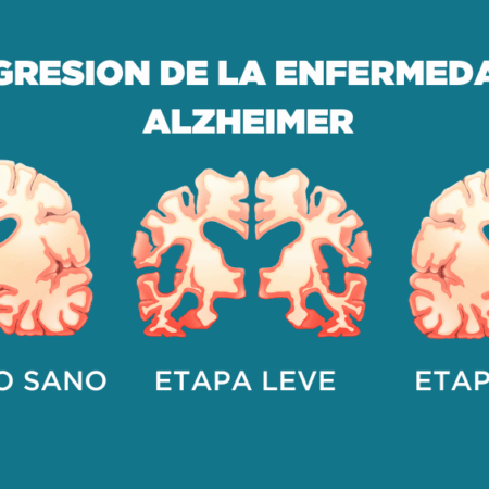 Um Passo Crucial: Revertendo os Danos Cerebrais na Doença de Alzheimer