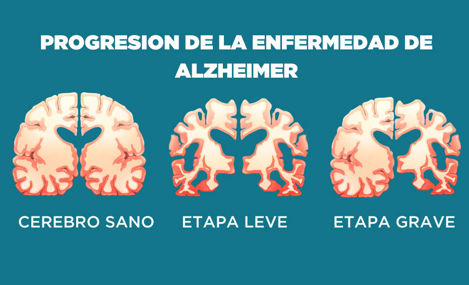 Preview Um Passo Crucial: Revertendo os Danos Cerebrais na Doença de Alzheimer