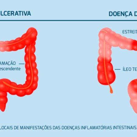 O Efeito Paradoxal do Tabagismo Revelado: Implicações nas Doenças Inflamatórias Intestinais