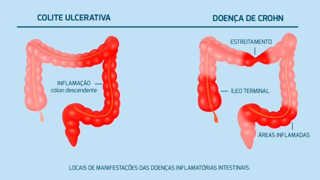Preview O Efeito Paradoxal do Tabagismo Revelado: Implicações nas Doenças Inflamatórias Intestinais