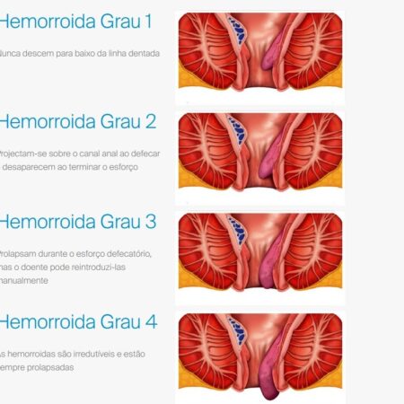Um Fator Surpreendente no Desenvolvimento de Hemorroidas Foi Revelado