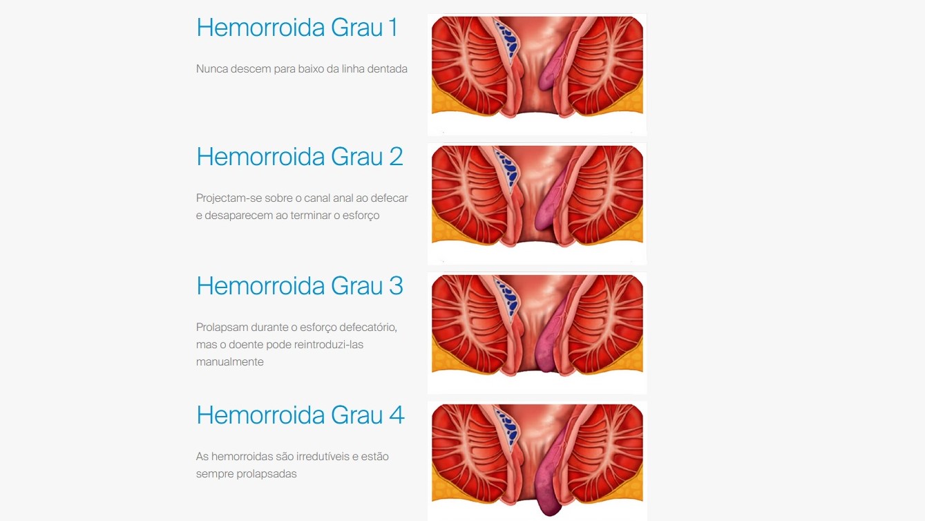 Preview Um Fator Surpreendente no Desenvolvimento de Hemorroidas Foi Revelado