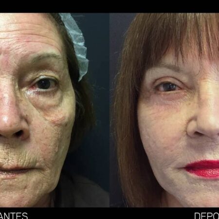 Efeito Inesperado de Rejuvenescimento da Chenagliflozina: Novas Descobertas