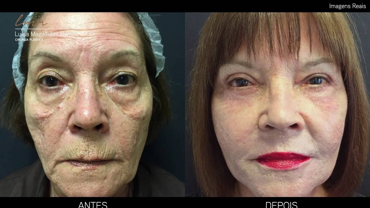 Preview Efeito Inesperado de Rejuvenescimento da Chenagliflozina: Novas Descobertas