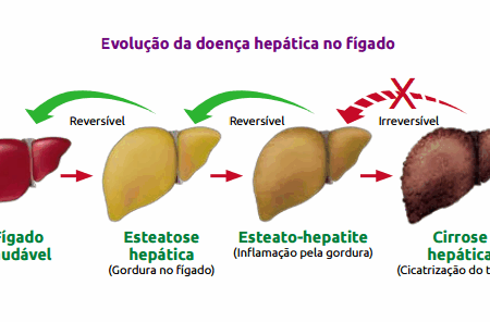 Identificados os Fatores Mais Perigosos de Mortalidade na Doença Hepática