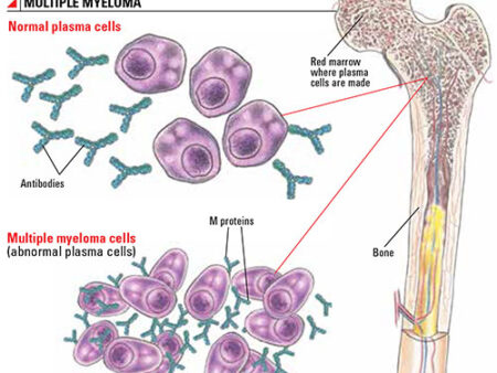 Nova Abordagem para o Tratamento do Mieloma Múltiplo: Bloqueio da Enzima STK17B Induz a Morte de Células Cancerígenas