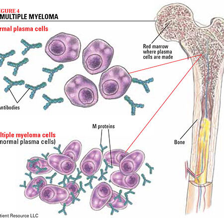 Nova Abordagem para o Tratamento do Mieloma Múltiplo: Bloqueio da Enzima STK17B Induz a Morte de Células Cancerígenas