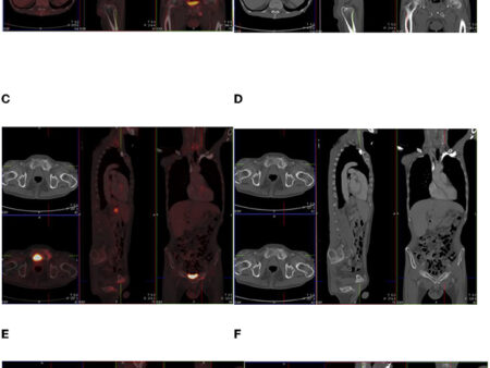 Agonistas GLP-1 Podem Distorcer Resultados de Exames PET-CT Oncológicos