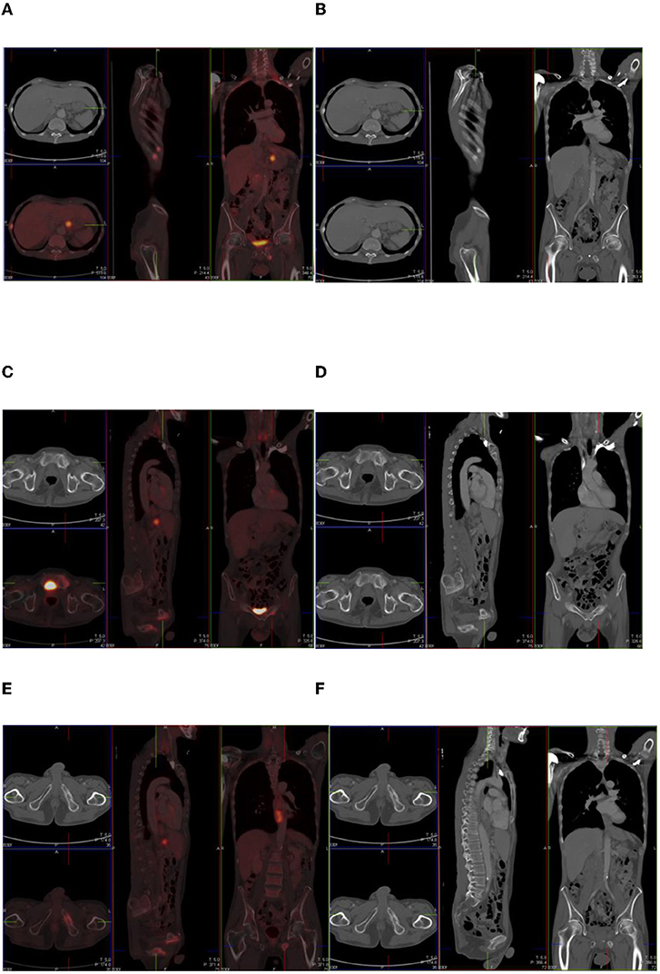 Preview Agonistas GLP-1 Podem Distorcer Resultados de Exames PET-CT Oncológicos