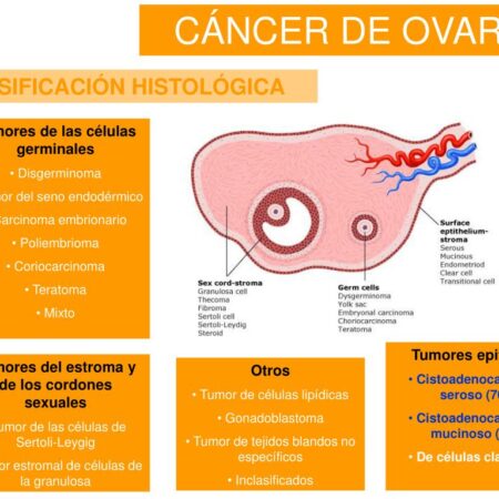 Vulnerabilidade em Câncer de Ovário Mortal Descoberta por Cientistas
