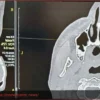 Уникальная операция в Орске: Хирурги удалили зуб из носовой пазухи пациента